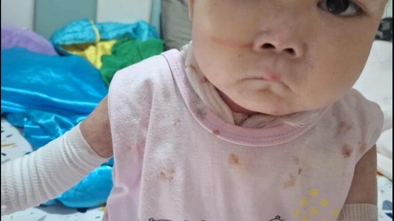 Epidermolysis Bullosa Stories: The Role of Support in Saving Children’s Lives