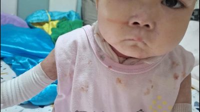 Epidermolysis Bullosa Stories: The Role of Support in Saving Children’s Lives