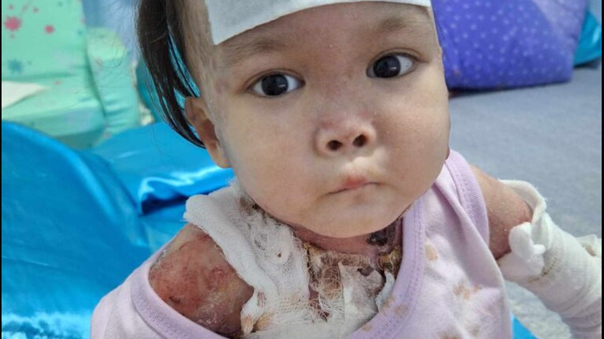 Can You Test For Epidermolysis Bullosa Before Birth? Diagnostic Methods Explored