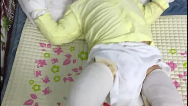EB Skin Disease Charity No Baby Blisters Renews Campaign For Pain Management