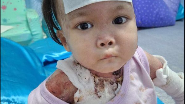 Epidermolysis Bullosa Prenatal Testing & Treatment: Donation Campaign Announced
