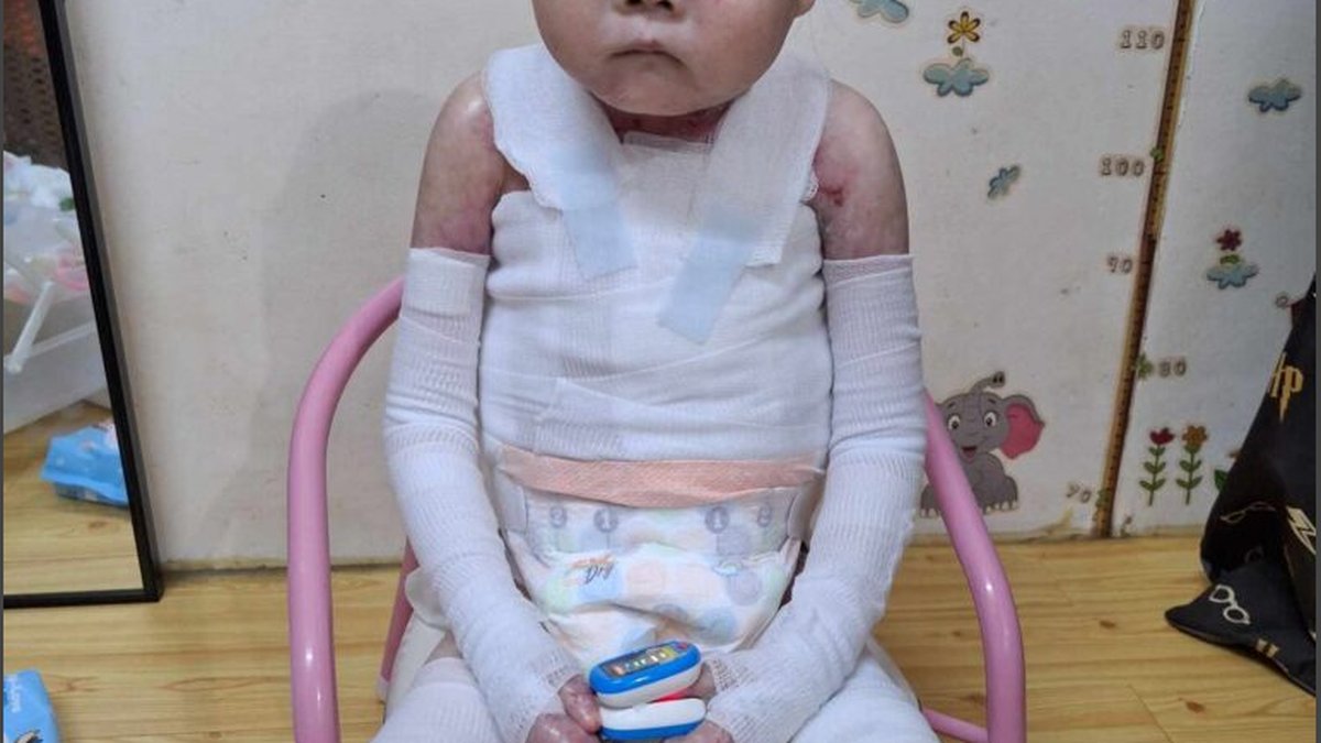 Fatal Complications Associated with Epidermolysis Bullosa: Experts Weigh In