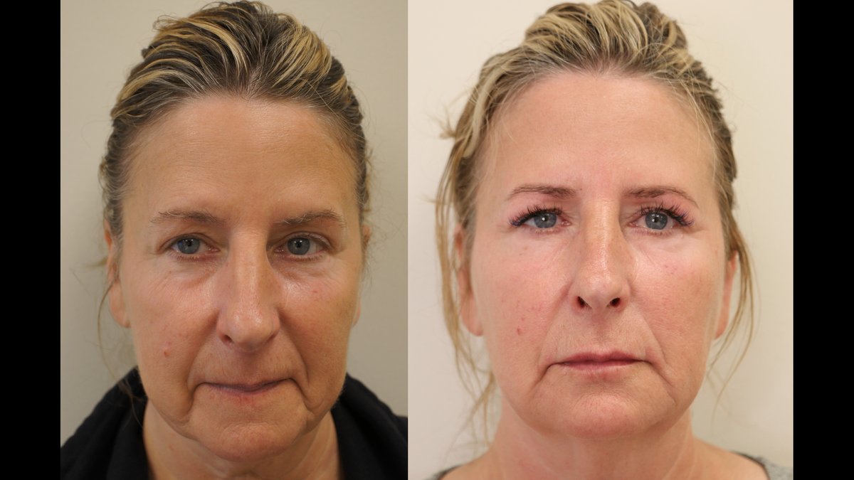 Injection Depth by Facial Zone: Balwin Aesthetics Doctor Explains Placement