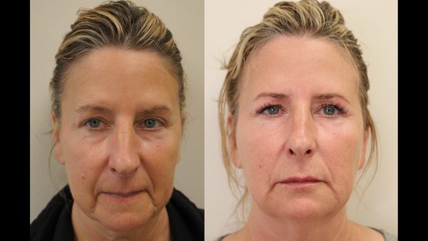 Non-Surgical Facelift Using Dermal Fillers Offered by Dr Sardesai, Balwin