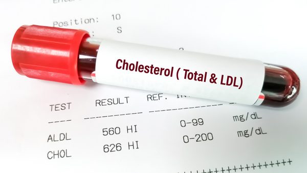 Testosterone Deficiency Effects On Cholesterol & Lipid Health: Guide Released