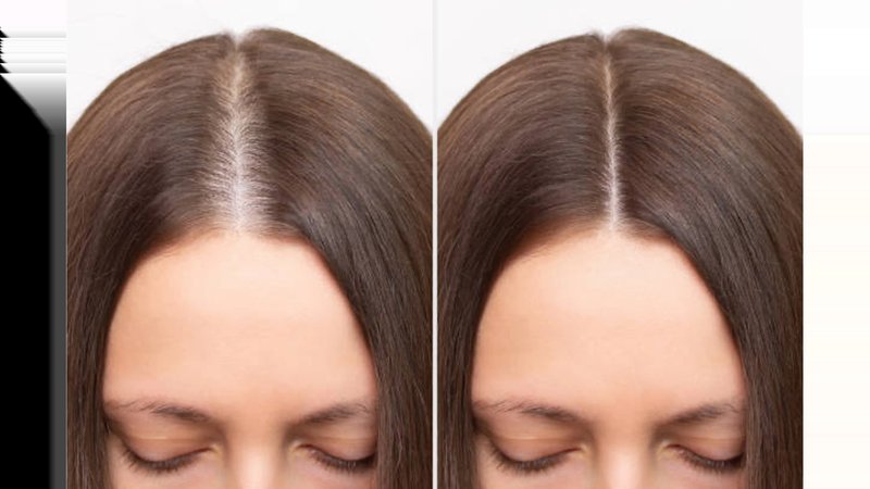 Thinning Hair vs Normal Hair Parting: How To Tell The Difference
