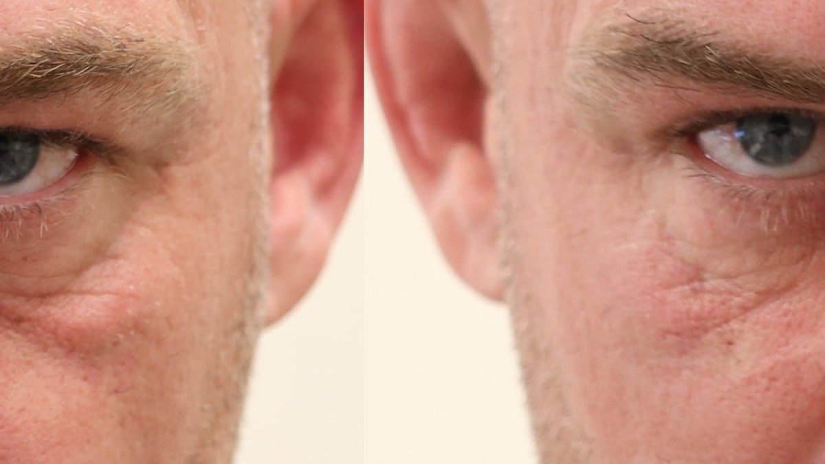 Under Eye Filler: Balwin Aesthetics Physician Explains Injection Depth