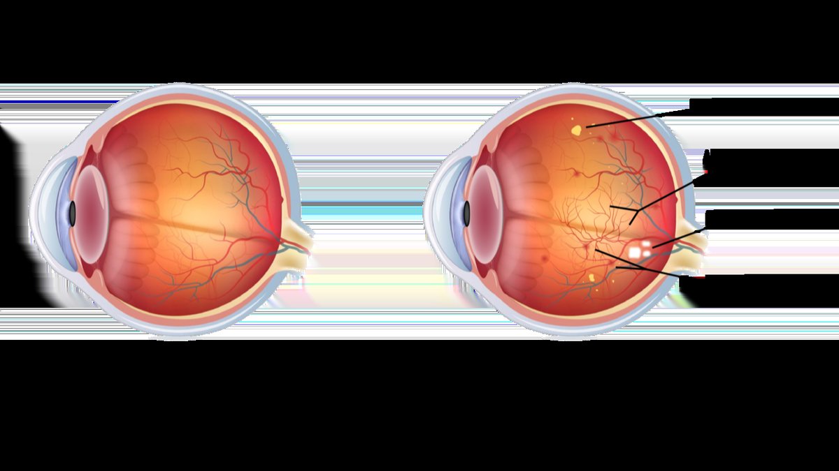 Jackson Heights Diabetes Eye Care: Appointments To Prevent Retinopathy Announced