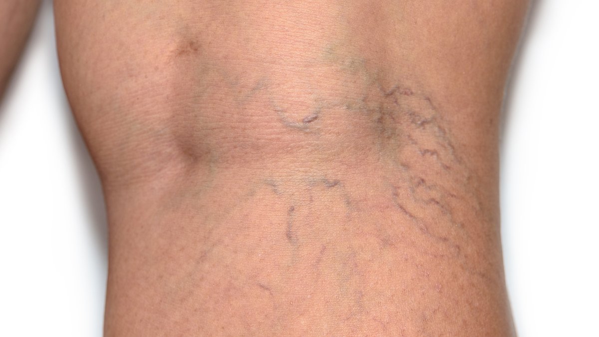Varicose Vein Appearance Reduction Home Remedies: Foot Bathing Guide Published