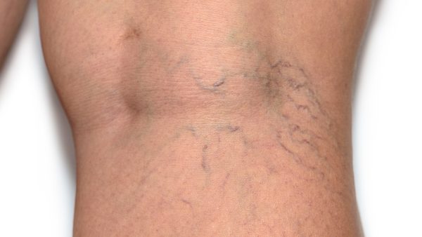 Varicose Vein Appearance Reduction Home Remedies: Foot Bathing Guide Published