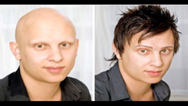 Custom Hair Replacement Systems: Non-Surgical Restoration Techniques