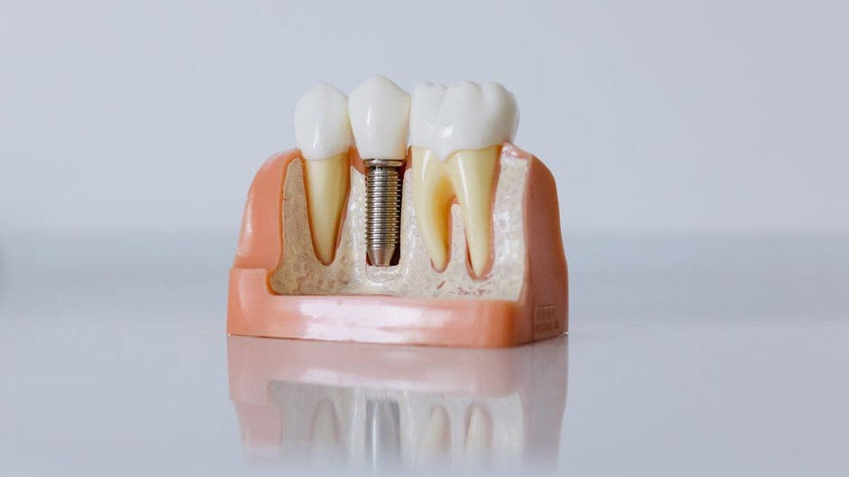 Single Tooth Implant: Nottingham Dentist Explains Treatment, Benefits & Recovery