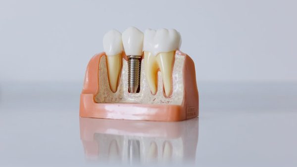 Single Tooth Implant: Nottingham Dentist Explains Treatment, Benefits & Recovery