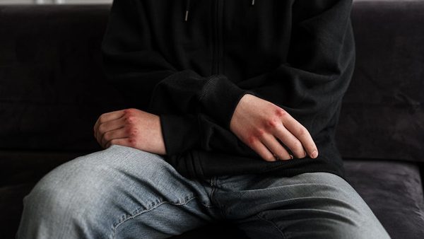 Teen Self-Harm Treatment: Yuba City Expert Explains When and How IOP Can Help