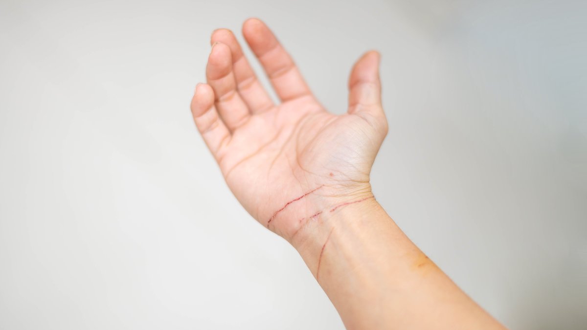 6 Warning Signs of Self-Harm in Teens That Parents Should Know